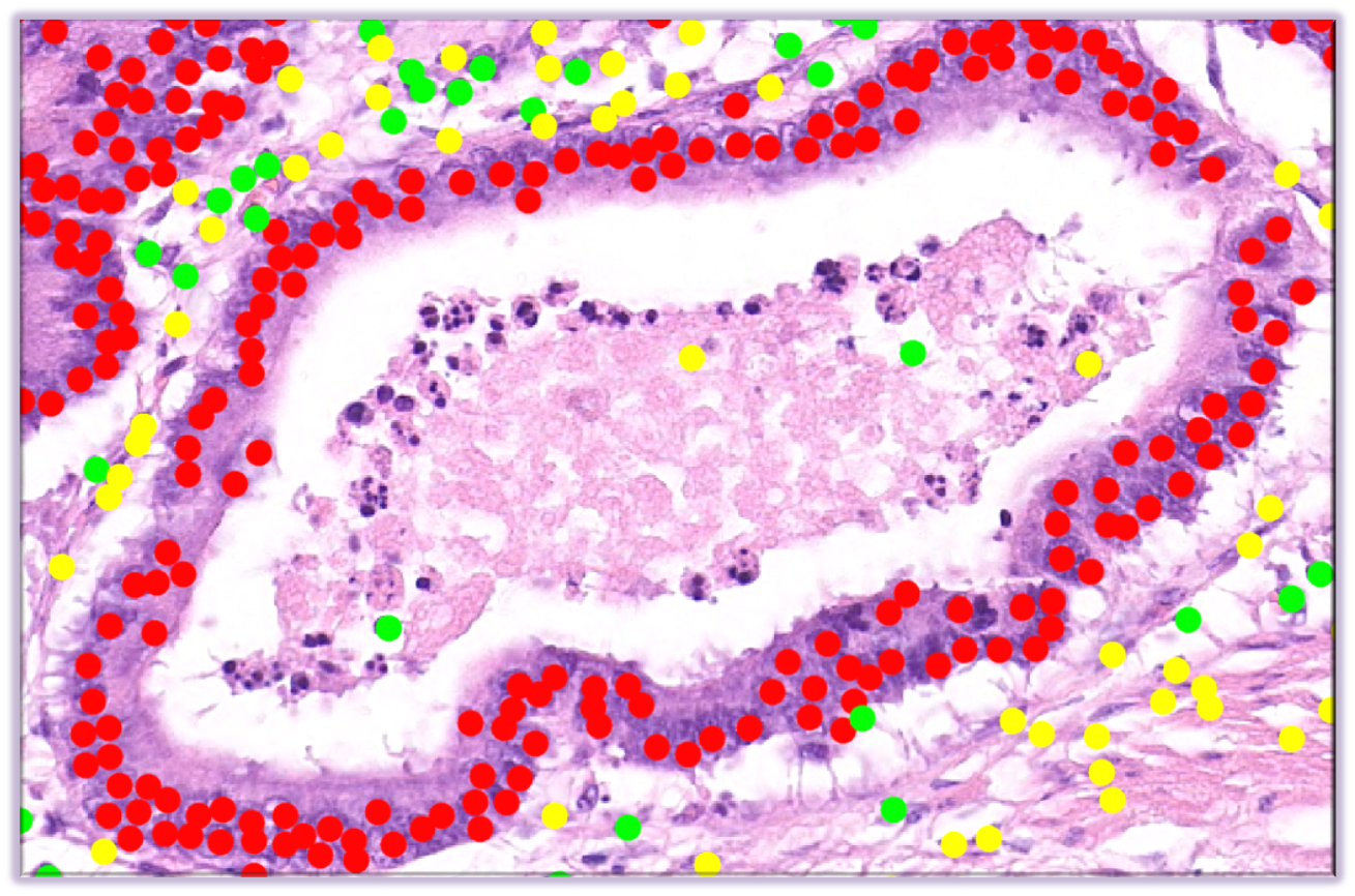 Microscopic landscape of various types of cells - including tumour cells (in red).
