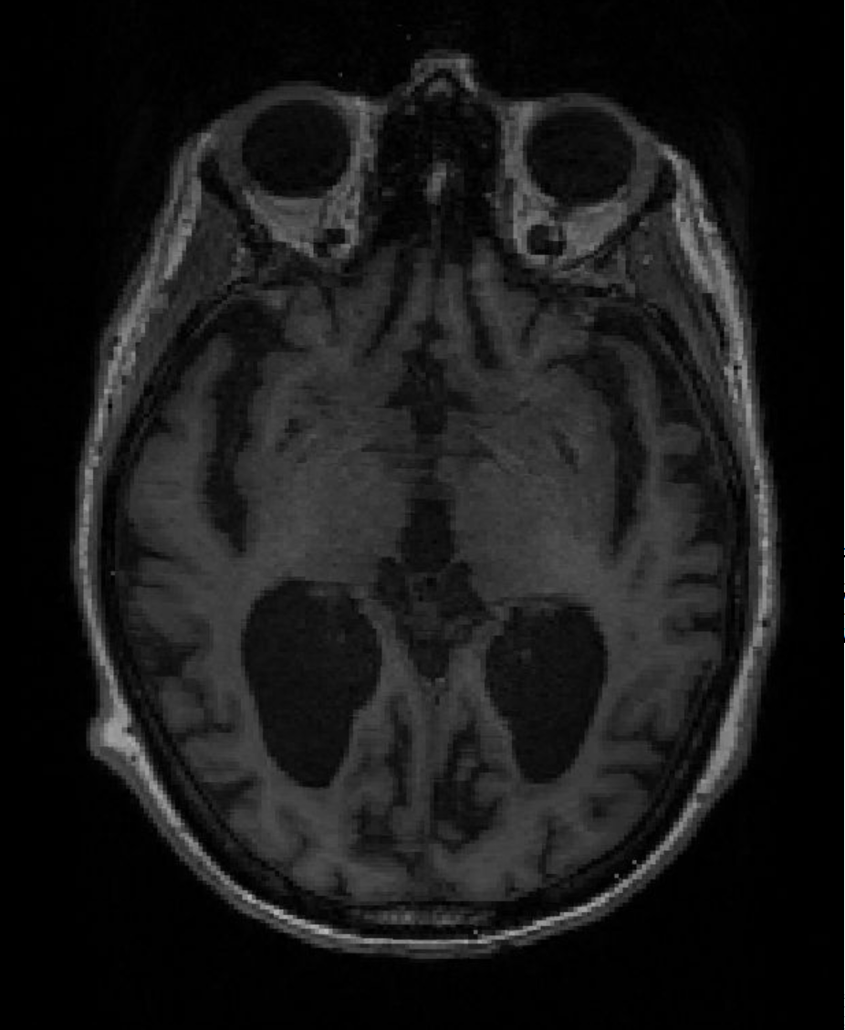 MRI brain scan of Alzheimer's patient (Credit: TImothy Rittman)