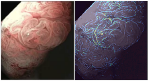 A colonoscopy image and heatmap of a precancerous polyp