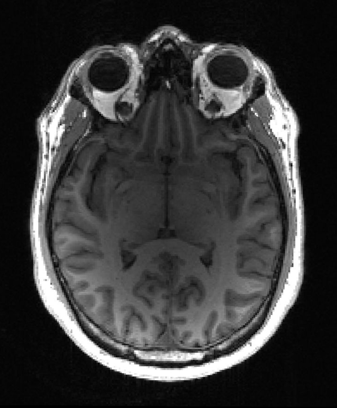 MRI brain scan of healthy volunteer (Credit: Timothy Rittman)